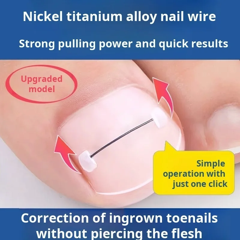 Nail Inlay Corrective Nail Wire Nail Inlay Corrective Nail Wire Nail Inlay Corrective Nail Wire Tool
Nail Inlay Corrective Nail Wire Nail Inlay Corrective Nail Wire Nail Inlay Corrective Nail Wire Tool