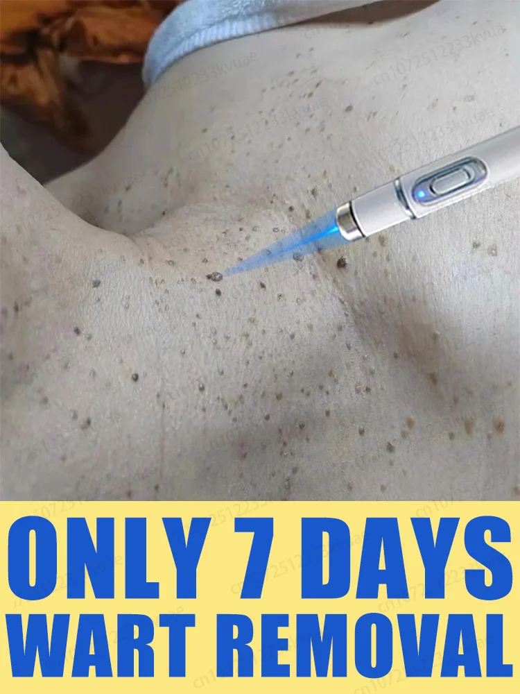 Hot selling blue light pen to solve body warts, wart care tools
Hot selling blue light pen to solve body warts, wart care tools