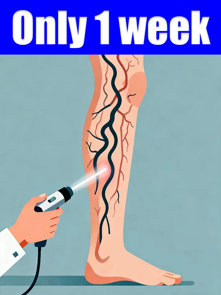 A special blue light pen for varicose veins with specific decay can be used.
A special blue light pen for varicose veins with specific decay can be used.