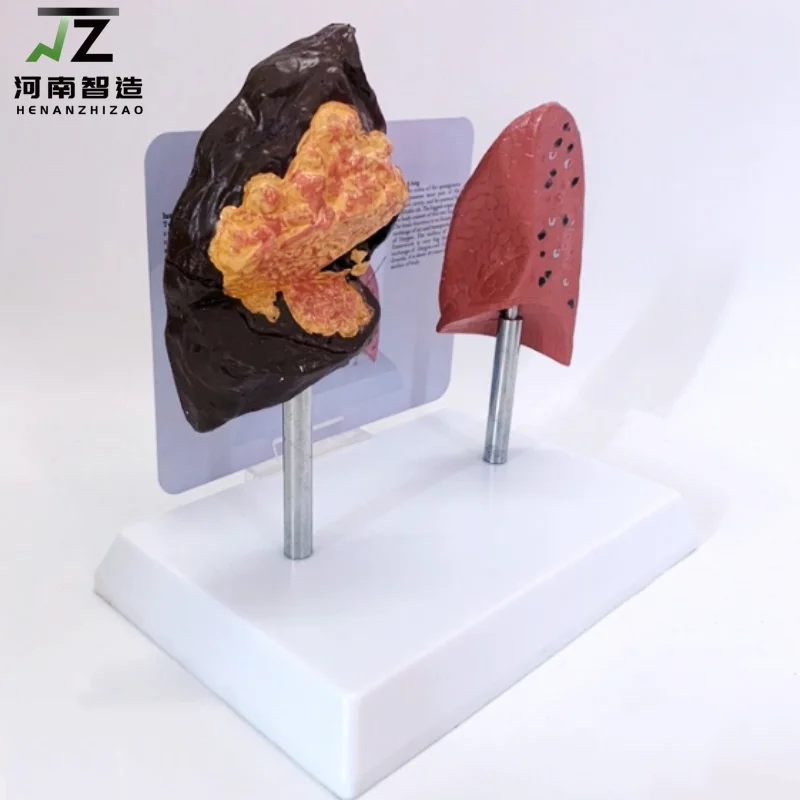 Comparative Model of Smoking Lung and Healthy Lung in Human Body Pathological Lung
Comparative Model of Smoking Lung and Healthy Lung in Human Body Pathological Lung
