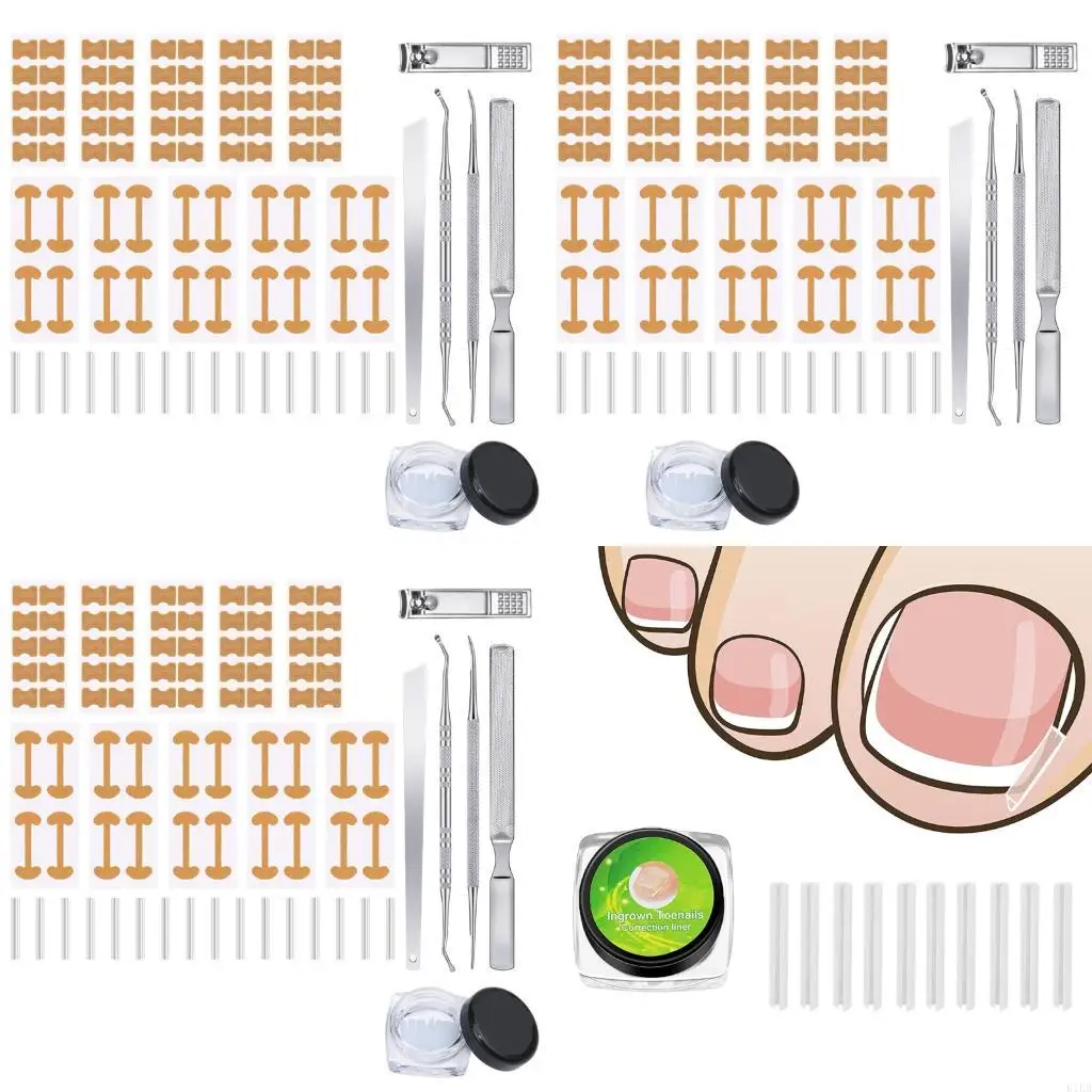 Professional Ingrown Toenail Corrector Set Steel Tool For Painless Relief
Professional Ingrown Toenail Corrector Set Steel Tool For Painless Relief