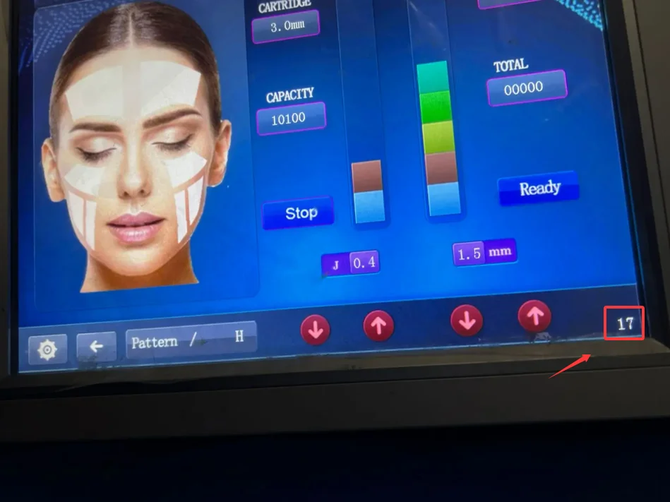 Специальная головка картриджа HIFU с внутренним диаметром 17, детали можно заменить без воды, аксессуары для машин для борьбы с морщинами и подтяжки кожи.
Специальная головка картриджа HIFU с внутренним диаметром 17, детали можно заменить без воды, аксессуары для машин для борьбы с морщинами и подтяжки кожи.