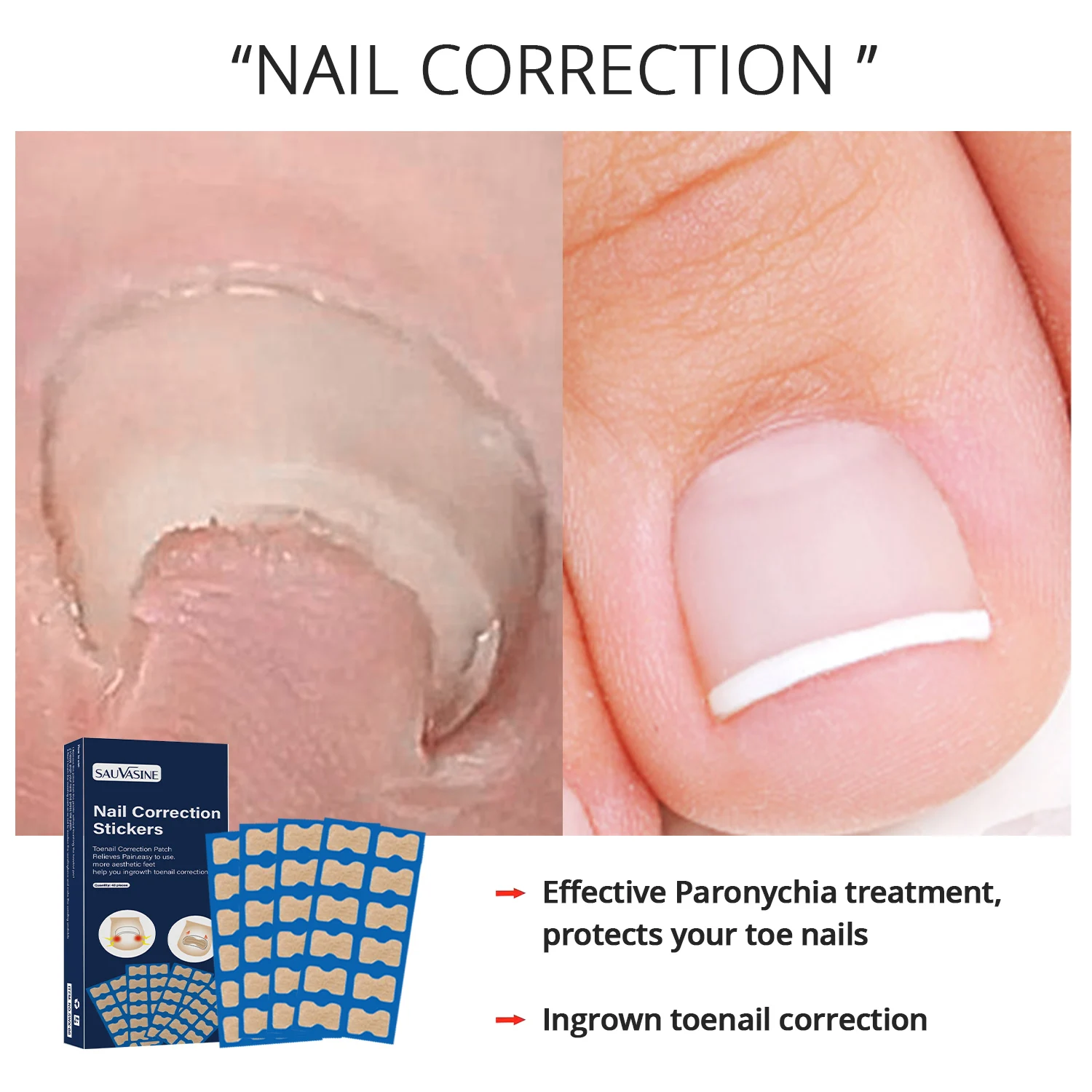 50pcs/500pcs Nail Ingrown Correction Stickers Patches Waterproof Paronychia Treatment Recover Corrector Pedicure Tool Feet Care
50pcs/500pcs Nail Ingrown Correction Stickers Patches Waterproof Paronychia Treatment Recover Corrector Pedicure Tool Feet Care