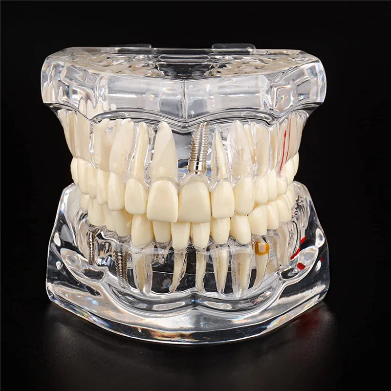 1 PCS Transparent Disease Teeth Model With Implant Bridge, Transparent Plastic For Patient And Student Education
1 PCS Transparent Disease Teeth Model With Implant Bridge, Transparent Plastic For Patient And Student Education
