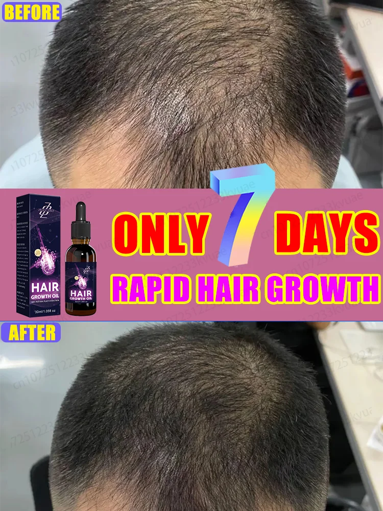 ᴬˡˡ ʸᵒᵘ ⁿᵉᵉᵈ ᵗᵒ ʰᵃᵛᵉ thick hair is a bottle of this seven-day fast-acting hair growth essential oil
ᴬˡˡ ʸᵒᵘ ⁿᵉᵉᵈ ᵗᵒ ʰᵃᵛᵉ thick hair is a bottle of this seven-day fast-acting hair growth essential oil