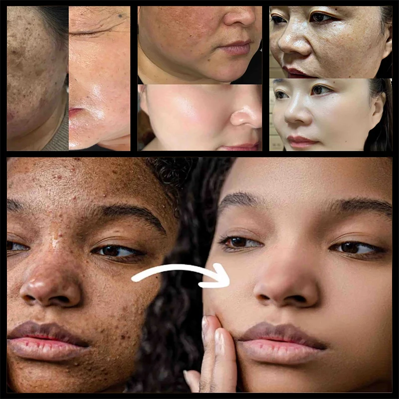 Pawpaw Vitamin C Essence Fade Melasma Melanin Dark Spots Freckles Whitening Face Serum Brighten Nourish Skin Care Beauty Korean
Pawpaw Vitamin C Essence Fade Melasma Melanin Dark Spots Freckles Whitening Face Serum Brighten Nourish Skin Care Beauty Korean