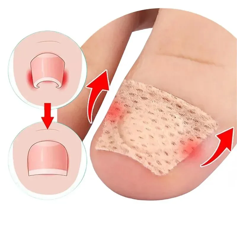 50 шт., инструмент для коррекции вросшего ногтя, инструмент для лечения вросшего пальца, патч-наклейка, инструмент для ухода за ногами для педикюра
50 шт., инструмент для коррекции вросшего ногтя, инструмент для лечения вросшего пальца, патч-наклейка, инструмент для ухода за ногами для педикюра