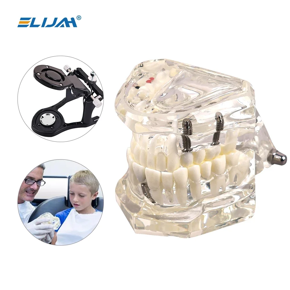 Denspay Dental Implantation Disease Teeth Mode with Restoration Bridge Tooth Dentist Training and Teaching Model
Denspay Dental Implantation Disease Teeth Mode with Restoration Bridge Tooth Dentist Training and Teaching Model