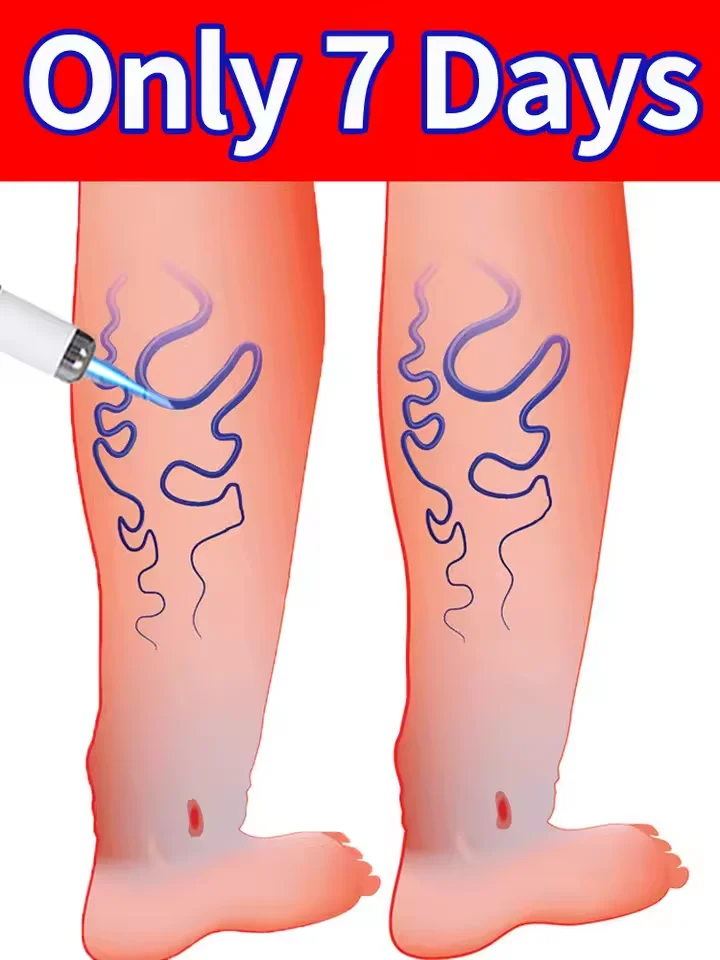 Vᴀʀɪᴄᴏsᴇ ᴠᴇɪɴ ʟᴀsᴇʀ ɪɴsᴛʀᴜᴍᴇɴᴛ
Vᴀʀɪᴄᴏsᴇ ᴠᴇɪɴ ʟᴀsᴇʀ ɪɴsᴛʀᴜᴍᴇɴᴛ