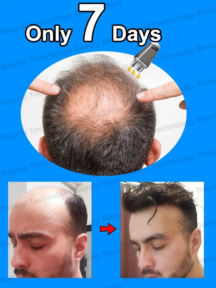 Scalp applicator, head minor applicator, dil hair growth solution, ball massage essential oil, introduction, comb coating
Scalp applicator, head minor applicator, dil hair growth solution, ball massage essential oil, introduction, comb coating