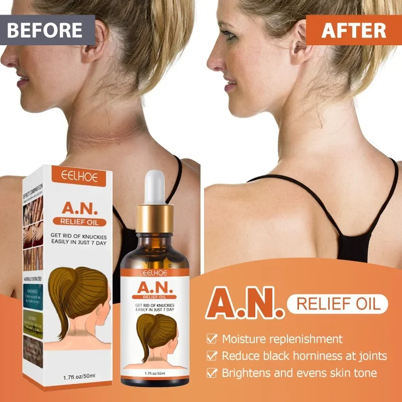 Sdottor New Whitening brightening essential oil Armpit Buttock Lightening Remove Underarm arm Knee joints Bleach exfoliating sk
Sdottor New Whitening brightening essential oil Armpit Buttock Lightening Remove Underarm arm Knee joints Bleach exfoliating sk
