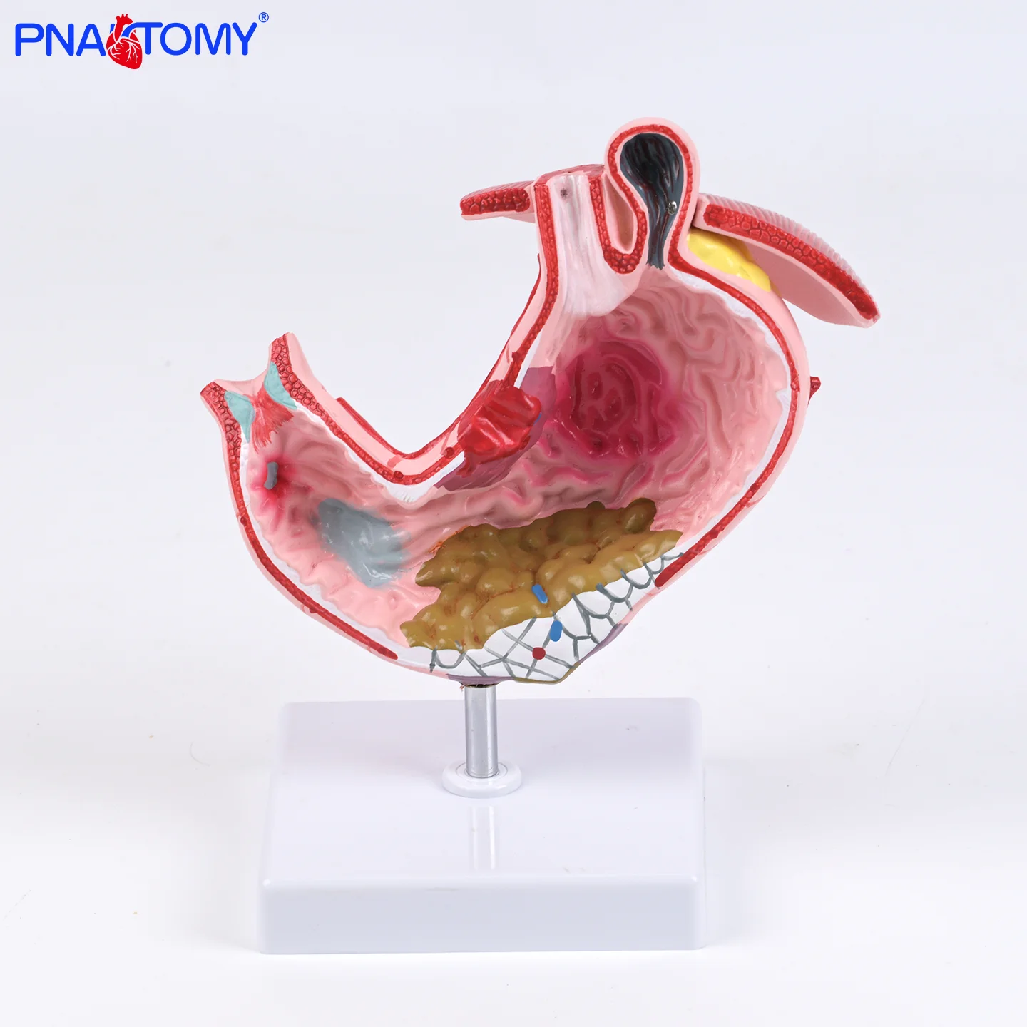Pathological stomach model, diseased stomach model, gastroenterology stomach coronal section anatomical Human Digestive System 
Pathological stomach model, diseased stomach model, gastroenterology stomach coronal section anatomical Human Digestive System