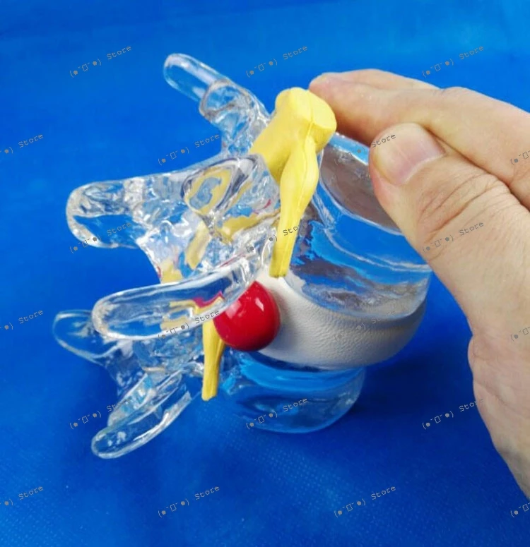 Spine and Spinal Cord Extrusion Disc Herniation Lumbar Disc Demonstration Model Lumbar Spine Model New Product
Spine and Spinal Cord Extrusion Disc Herniation Lumbar Disc Demonstration Model Lumbar Spine Model New Product