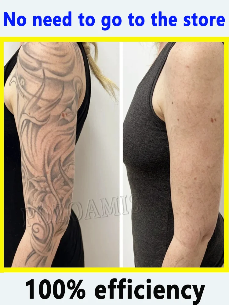 2025, ручка синего света удаляет татуировки всех размеров.
2025, ручка синего света удаляет татуировки всех размеров.