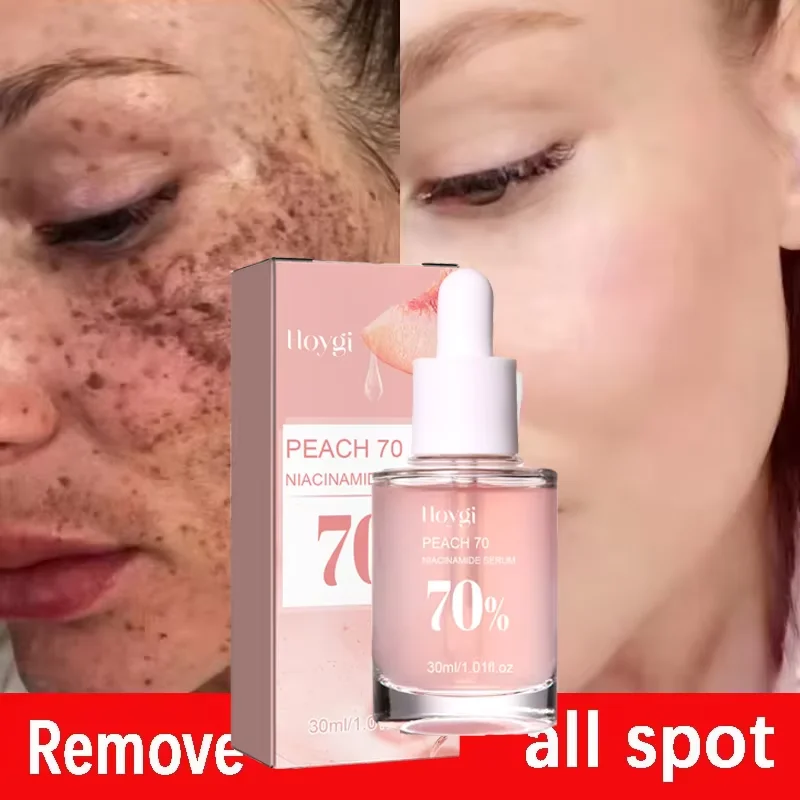 Niacinamide Whitening Freckles Serum Removal Melasma Dark Spots Lighten Melanin Pigmentation Brightening Anti-Aging Beauty Care
Niacinamide Whitening Freckles Serum Removal Melasma Dark Spots Lighten Melanin Pigmentation Brightening Anti-Aging Beauty Care