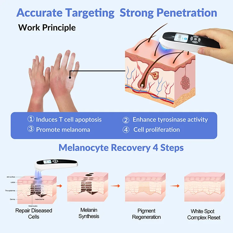 2026 Vitiligo Psoriasis Eczema Treatment Device 308nm Excimer Laser UVB Light Therapy for Lip Vitiligo Repair
2026 Vitiligo Psoriasis Eczema Treatment Device 308nm Excimer Laser UVB Light Therapy for Lip Vitiligo Repair