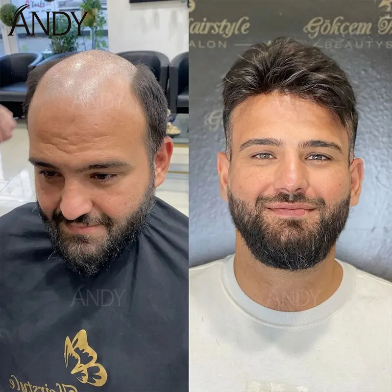 130% Density Men Toupee 0.12-0.14mm PU Full Thickness Skin Base Indian Remy Human Hair Men's Hair Prosthesis Replacement Wig
130% Density Men Toupee 0.12-0.14mm PU Full Thickness Skin Base Indian Remy Human Hair Men's Hair Prosthesis Replacement Wig