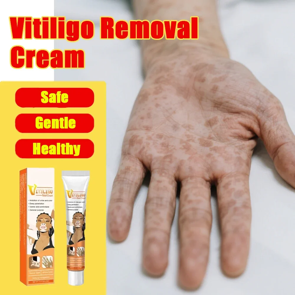 Vitiligo Care Cream for Skin White Spots Reduction Effective Spot Minimizing Formula
Vitiligo Care Cream for Skin White Spots Reduction Effective Spot Minimizing Formula