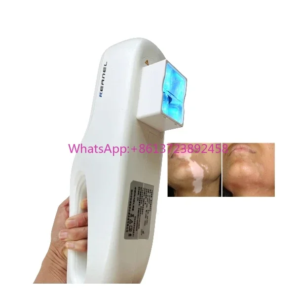 Kernel KN-5000E mini 308 nm excimer UV phototherapy machine for vitiligo psoriasis treatment
Kernel KN-5000E mini 308 nm excimer UV phototherapy machine for vitiligo psoriasis treatment