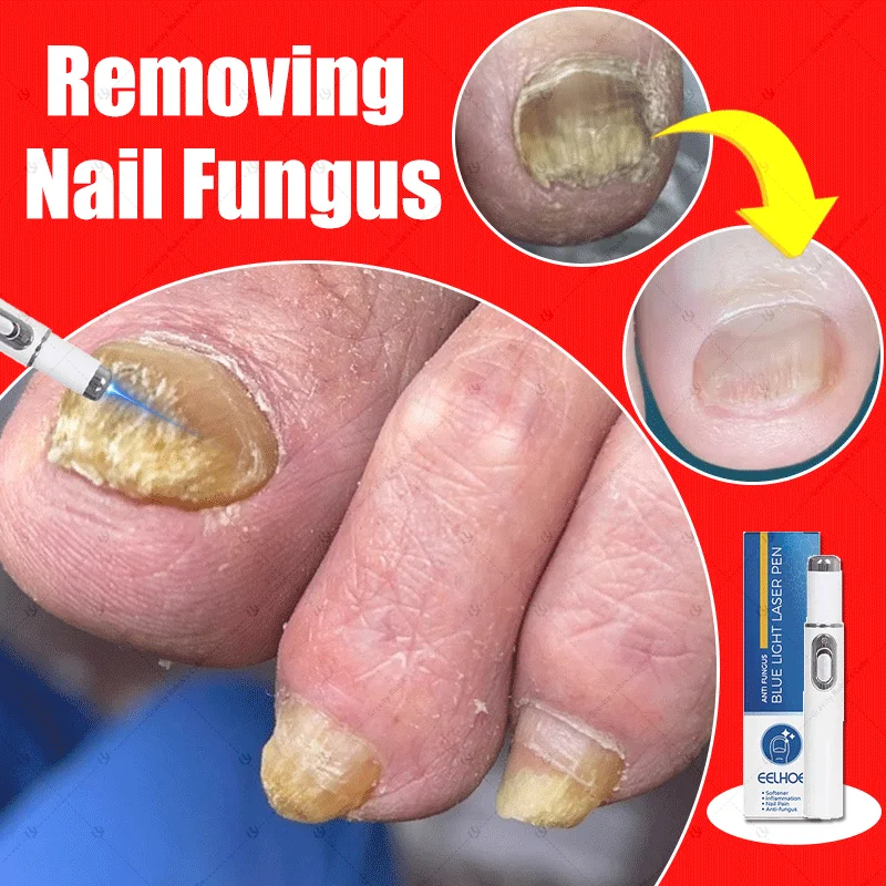 Fungus nail laser pointer helps to get rid of onychomycosis gray nail Painless and long-lasting sterilization anti-recurrence
Fungus nail laser pointer helps to get rid of onychomycosis gray nail Painless and long-lasting sterilization anti-recurrence