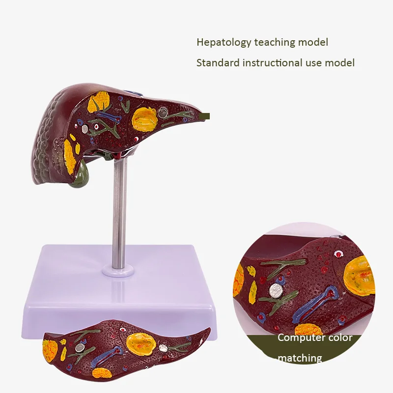Pathological Model of Liver Adipose Hepatic Sclerotic Liver Disease Transformed Into Anatomical Model of Human Liver
Pathological Model of Liver Adipose Hepatic Sclerotic Liver Disease Transformed Into Anatomical Model of Human Liver