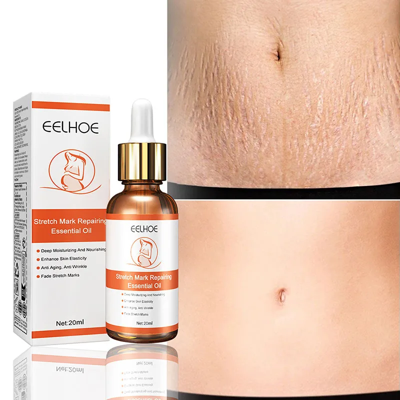 Stretch Marks Remover Essential Oil Pregnancy Maternity Body New Old Stretch Mark Removal Serum Increase Elasticity of Skin 20ml
Stretch Marks Remover Essential Oil Pregnancy Maternity Body New Old Stretch Mark Removal Serum Increase Elasticity of Skin 20ml