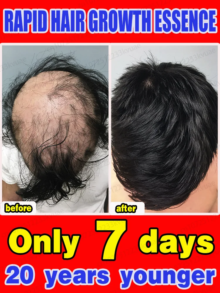 【Hair Growth Essence】Quickly activate hair follicles, effectively promote hair growth, and say goodbye to hair loss and baldness
【Hair Growth Essence】Quickly activate hair follicles, effectively promote hair growth, and say goodbye to hair loss and baldness