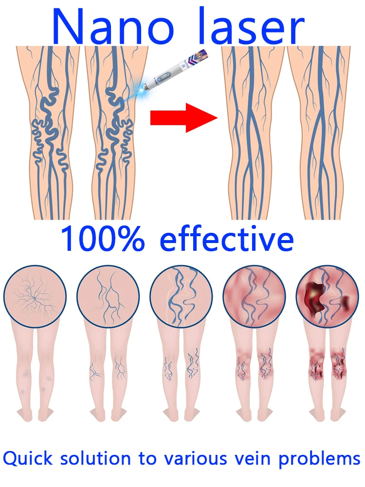 veinesPoderosa terapia a laser para varizes moderadas, alivia a dor e melhora a circulação para homens e mulheres
veinesPoderosa terapia a laser para varizes moderadas, alivia a dor e melhora a circulação para homens e mulheres