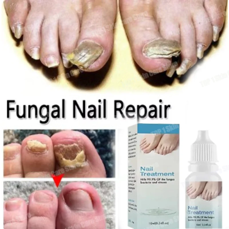 NewNail Fungals Renewal Nail Repair Liquid for Discolored Thickened Crumbled Nails Nail Fungals for Discolored Broken Cracked
NewNail Fungals Renewal Nail Repair Liquid for Discolored Thickened Crumbled Nails Nail Fungals for Discolored Broken Cracked