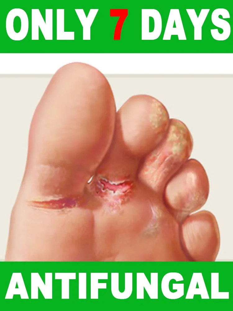 Fᴏᴏᴛ Cʟᴇᴀɴsɪɴɢ Sᴘʀᴀʏ Restore Health Nail Tools, Gentle Penetration, Herbal Formula
Fᴏᴏᴛ Cʟᴇᴀɴsɪɴɢ Sᴘʀᴀʏ Restore Health Nail Tools, Gentle Penetration, Herbal Formula