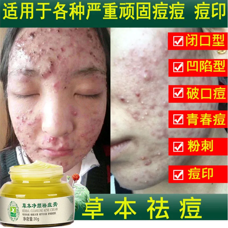 Remove acne marks and pits female and male students acne non-acne closed-mouth repair household acne removal cream Skincare
Remove acne marks and pits female and male students acne non-acne closed-mouth repair household acne removal cream Skincare