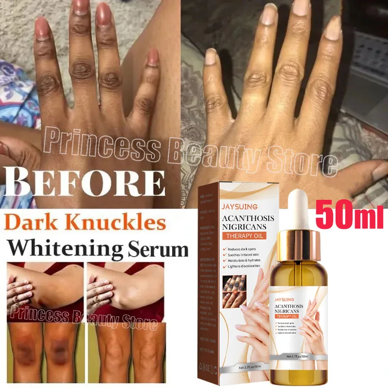 Dark Knuckles Fast Whitening Serum Anti Cracking Products Pigmentation Correctors For Black Skin Intense Stains Remover Essence
Dark Knuckles Fast Whitening Serum Anti Cracking Products Pigmentation Correctors For Black Skin Intense Stains Remover Essence