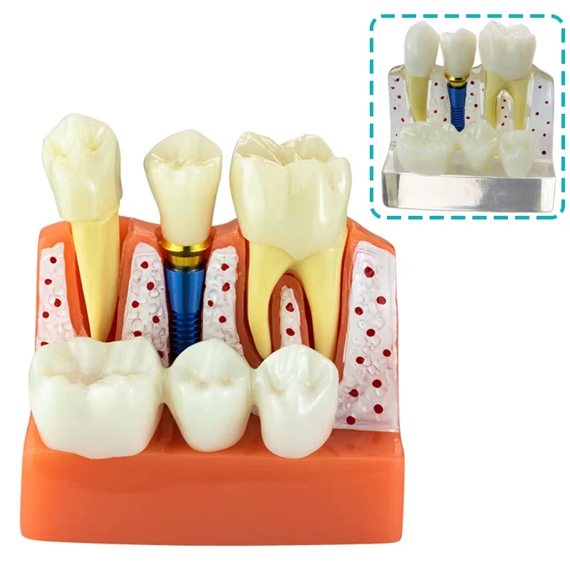 4-кратная модель зубного имплантата, анализ имплантатов, демонстрационная съемная модель, модель для исследования стоматолога
4-кратная модель зубного имплантата, анализ имплантатов, демонстрационная съемная модель, модель для исследования стоматолога