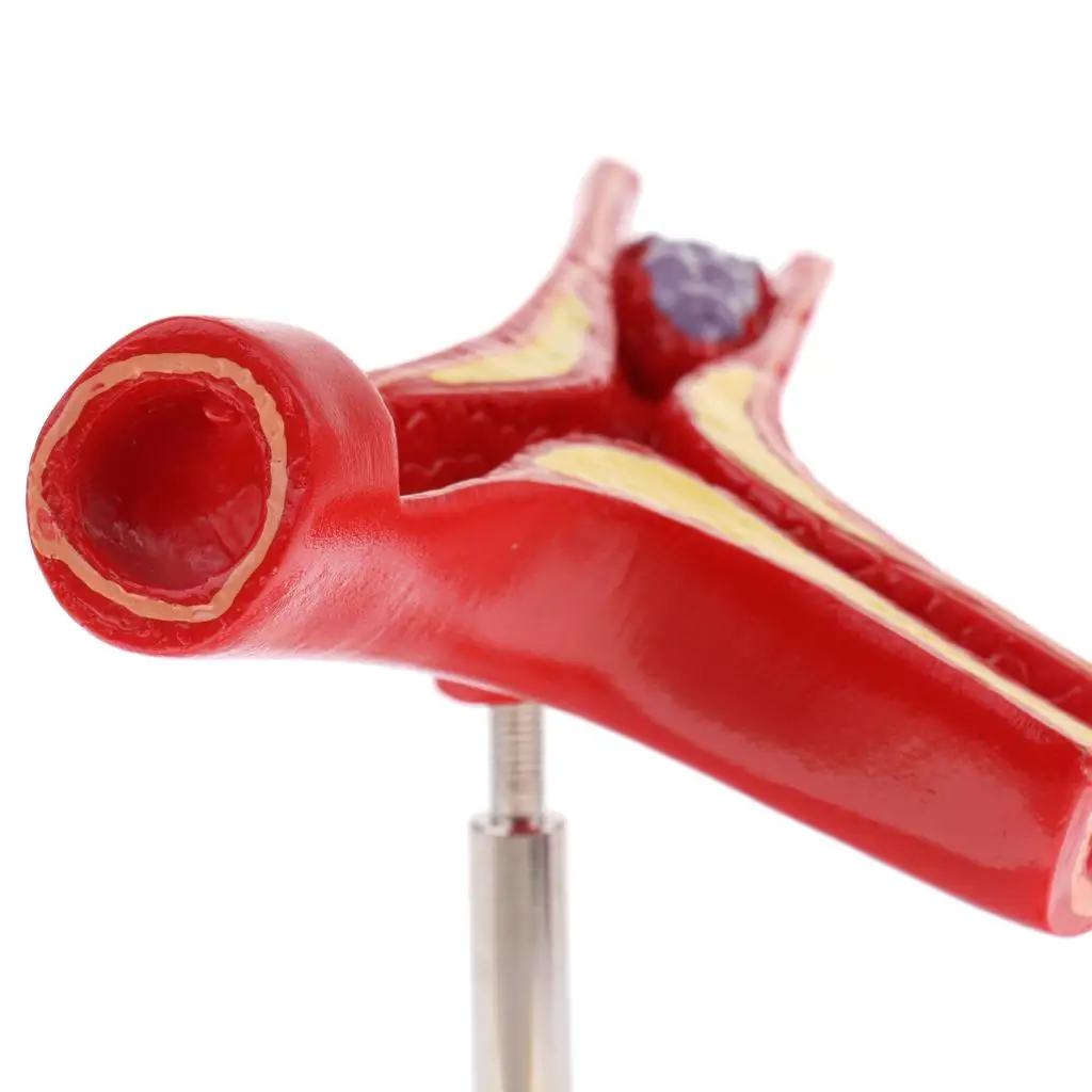 Human Vessel Thrombus Model Cross Section Anatomical Statue PVC Educational Lab Supplies for Medical Training
Human Vessel Thrombus Model Cross Section Anatomical Statue PVC Educational Lab Supplies for Medical Training
