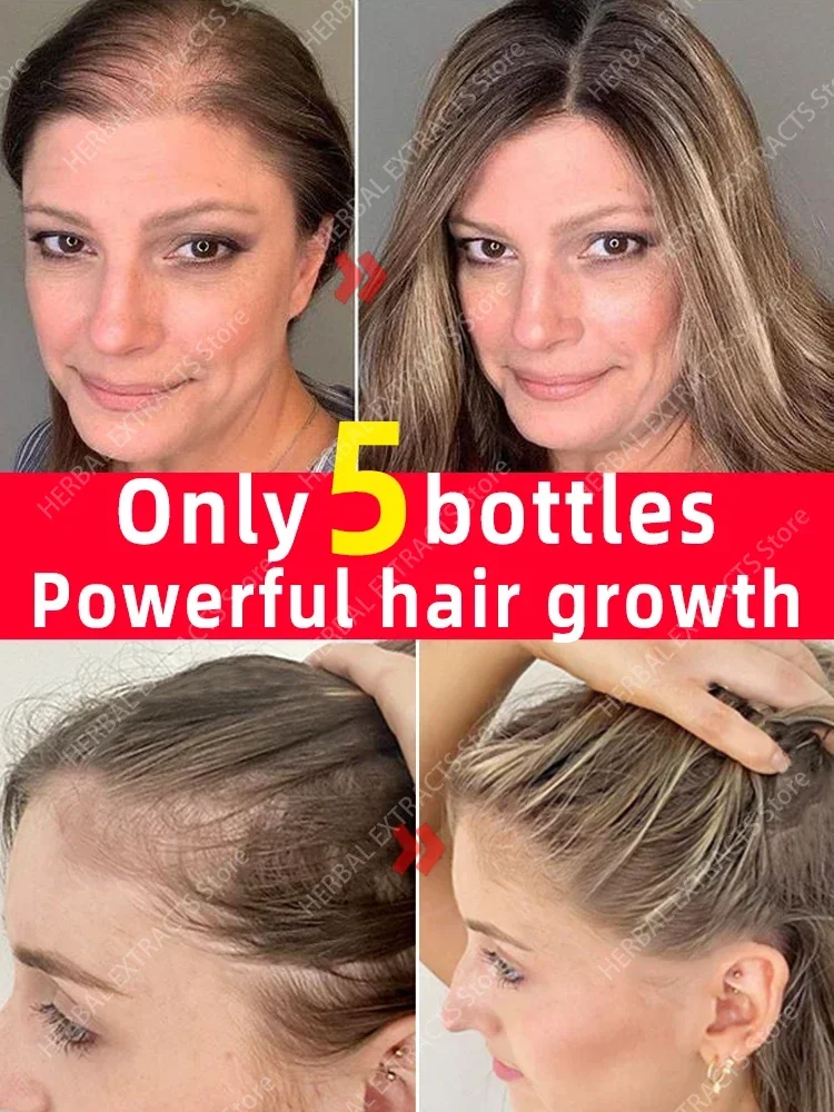 O óleo de crescimento capilar faz o cabelo crescer rapidamente, repara eficazmente a calvície e a queda de cabelo hereditária
O óleo de crescimento capilar faz o cabelo crescer rapidamente, repara eficazmente a calvície e a queda de cabelo hereditária