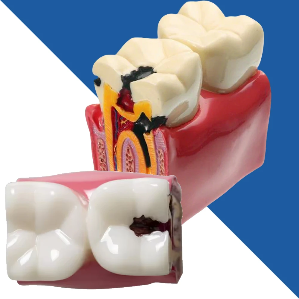 Dental Lab Teeth Model – 6× Caries Comparison for Dentist Training & Education
Dental Lab Teeth Model – 6× Caries Comparison for Dentist Training & Education
