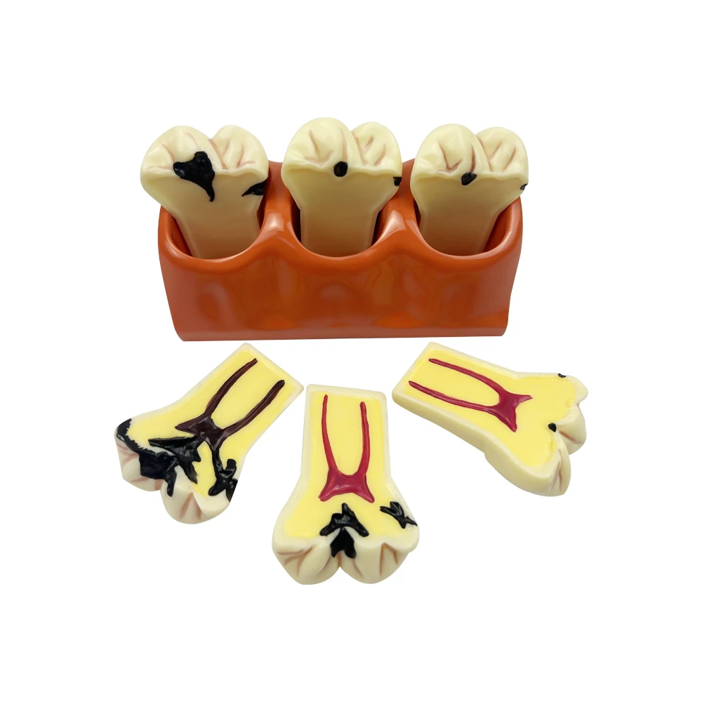 4time Dental Caries Model Teeth Teaching Tooth Caries Development Model For Education Studying Doctor-Patient Communication Demo
4time Dental Caries Model Teeth Teaching Tooth Caries Development Model For Education Studying Doctor-Patient Communication Demo