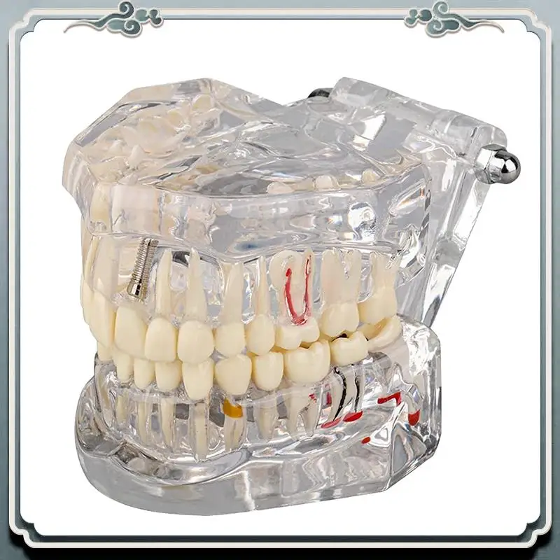 1 PCS Transparent Disease Teeth Model With Implant Bridge, Transparent Plastic For Patient And Student Education
1 PCS Transparent Disease Teeth Model With Implant Bridge, Transparent Plastic For Patient And Student Education