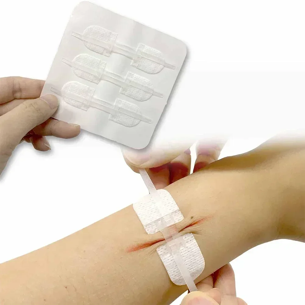Good priceWound Closure Patch Hemostatic Patch Wound Fast Suture Zipper Band-Aid Outdoor Portable Wound Closure Device manufactu
Good priceWound Closure Patch Hemostatic Patch Wound Fast Suture Zipper Band-Aid Outdoor Portable Wound Closure Device manufactu