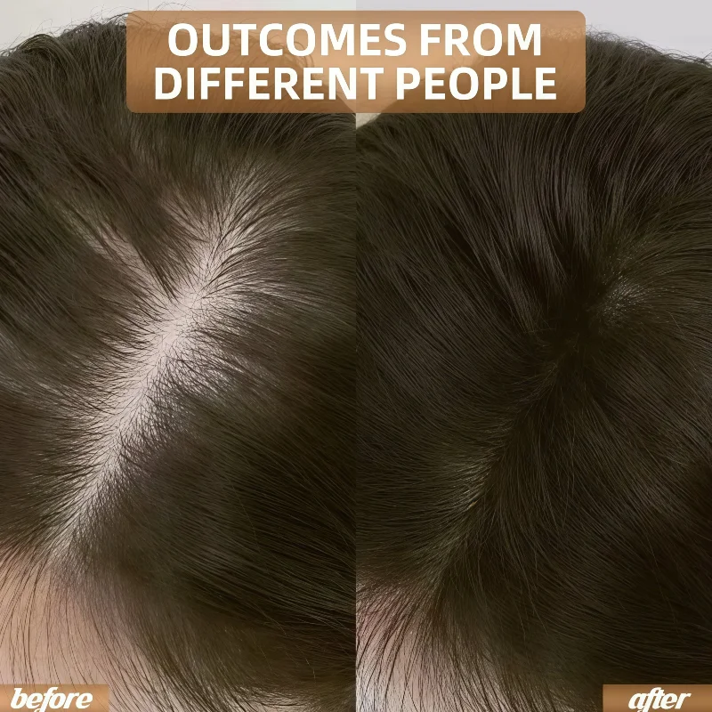 Усовершенствованный лазерный колпачок для роста волос, 925 диодов LLLT для лечения адометической алопеции с максимальным покрытием
Усовершенствованный лазерный колпачок для роста волос, 925 диодов LLLT для лечения адометической алопеции с максимальным покрытием