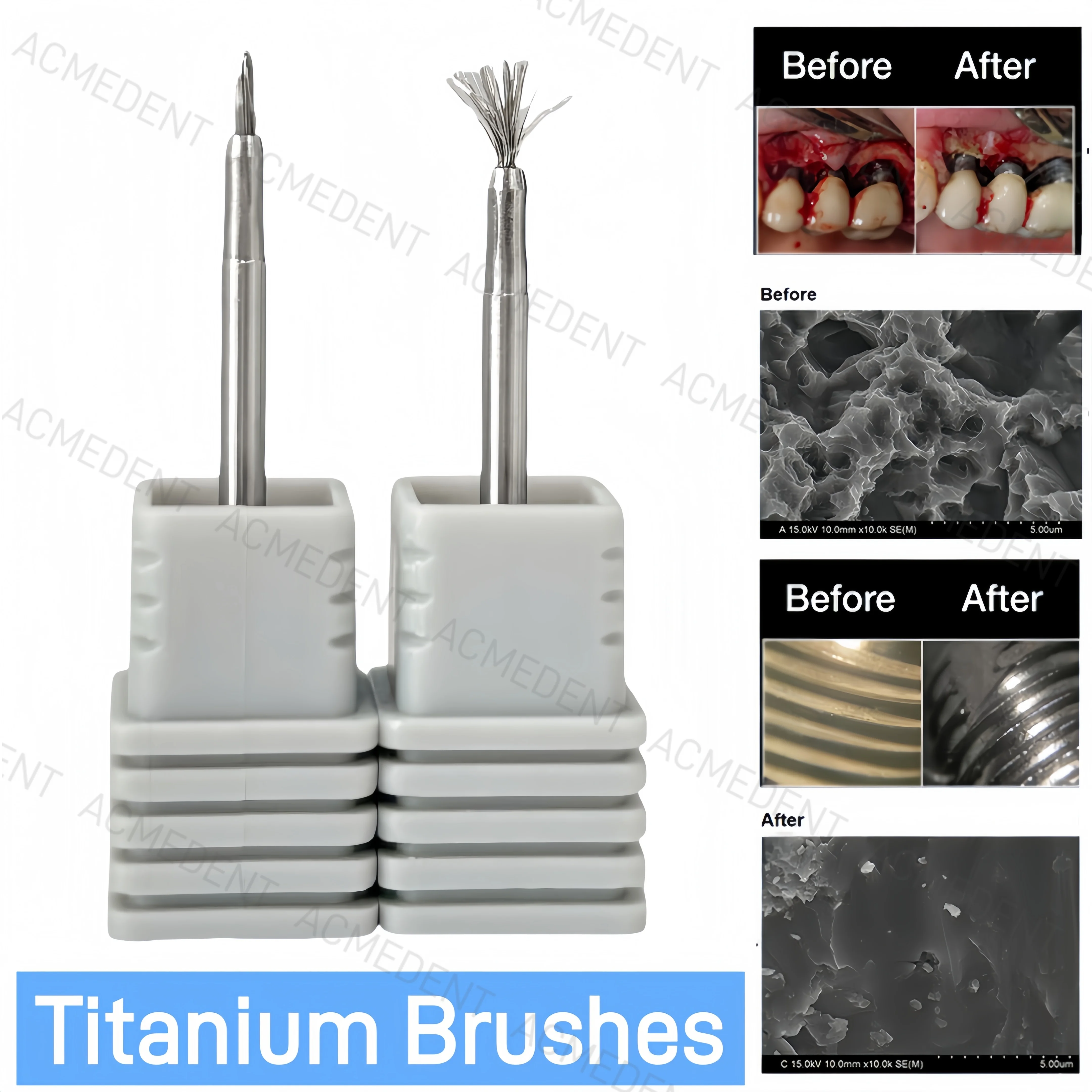 Dental Titanium Bristles Surface Cleaning Brush Peri-Implantits Implant Fixture Surface Threads Tool Debridement Taper Pocket
Dental Titanium Bristles Surface Cleaning Brush Peri-Implantits Implant Fixture Surface Threads Tool Debridement Taper Pocket