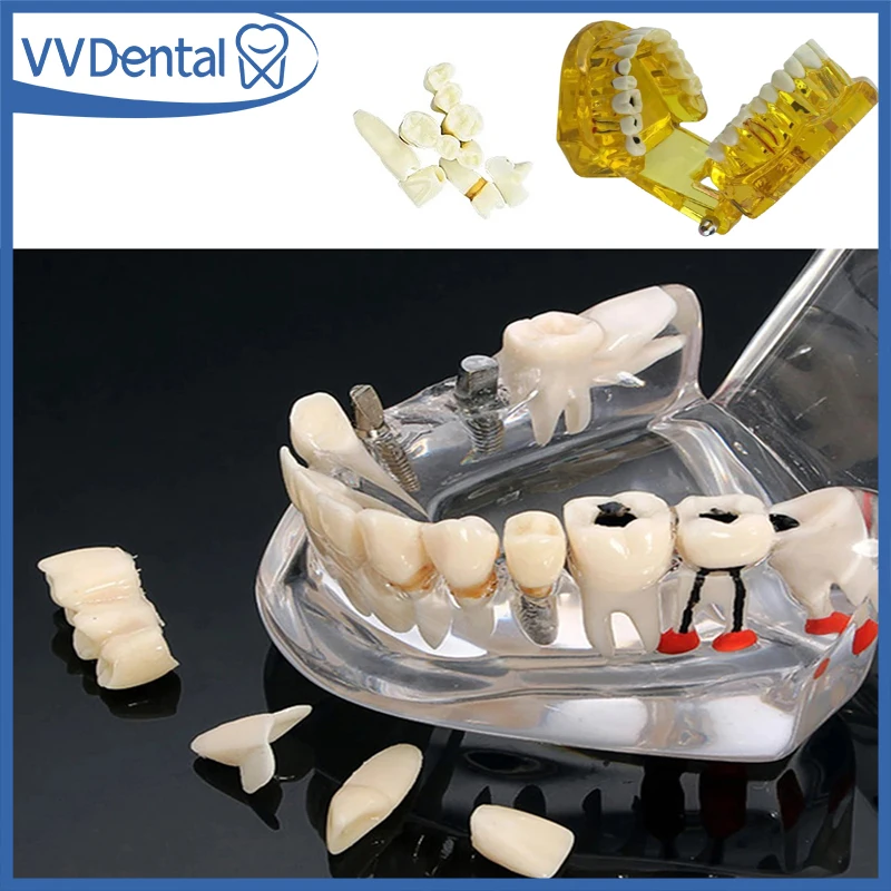 VVDental Teeth Repair Model Disease Teeth Model for Dentist Student Practice Training Studying Dentistry Tools
VVDental Teeth Repair Model Disease Teeth Model for Dentist Student Practice Training Studying Dentistry Tools