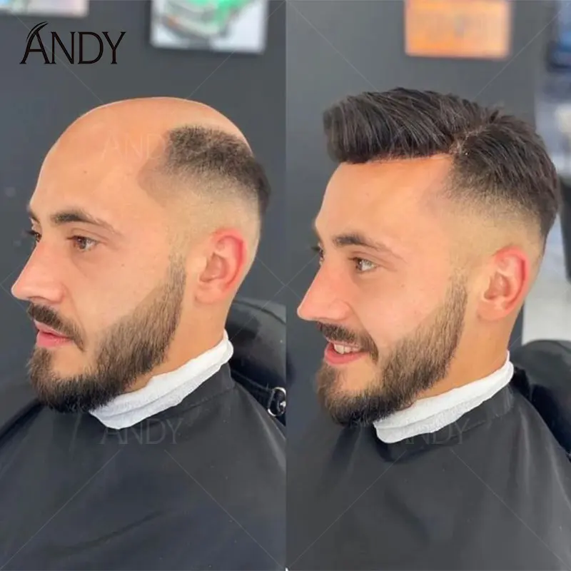 Ultra Realistic Male Hair Prosthesis 0.1mm Injection Skin Toupee Breathable Swiss Lace and PU Base Virgin Human Hair Men
Ultra Realistic Male Hair Prosthesis 0.1mm Injection Skin Toupee Breathable Swiss Lace and PU Base Virgin Human Hair Men