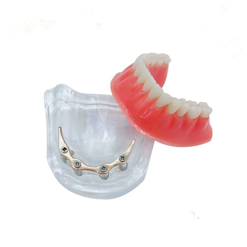 Overdenture implant model Denture Teeth mandibular model with golden bar Dental Teaching Model
Overdenture implant model Denture Teeth mandibular model with golden bar Dental Teaching Model