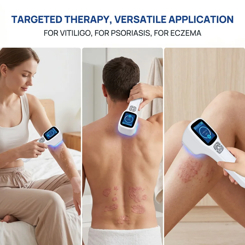 308nm Narrowband UVB Light for Repigmentation Home Phototherapy Unit for Stabilized Vitiligo and Mild Psoriasis Treatment
308nm Narrowband UVB Light for Repigmentation Home Phototherapy Unit for Stabilized Vitiligo and Mild Psoriasis Treatment
