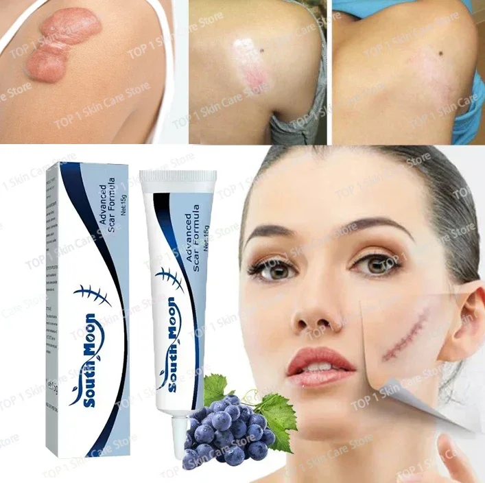NewScar Removal Old Scar Effective Repair New Scars Surgical Scars Stretch Marks Acne Pits Acne Marks Burn Scars
NewScar Removal Old Scar Effective Repair New Scars Surgical Scars Stretch Marks Acne Pits Acne Marks Burn Scars