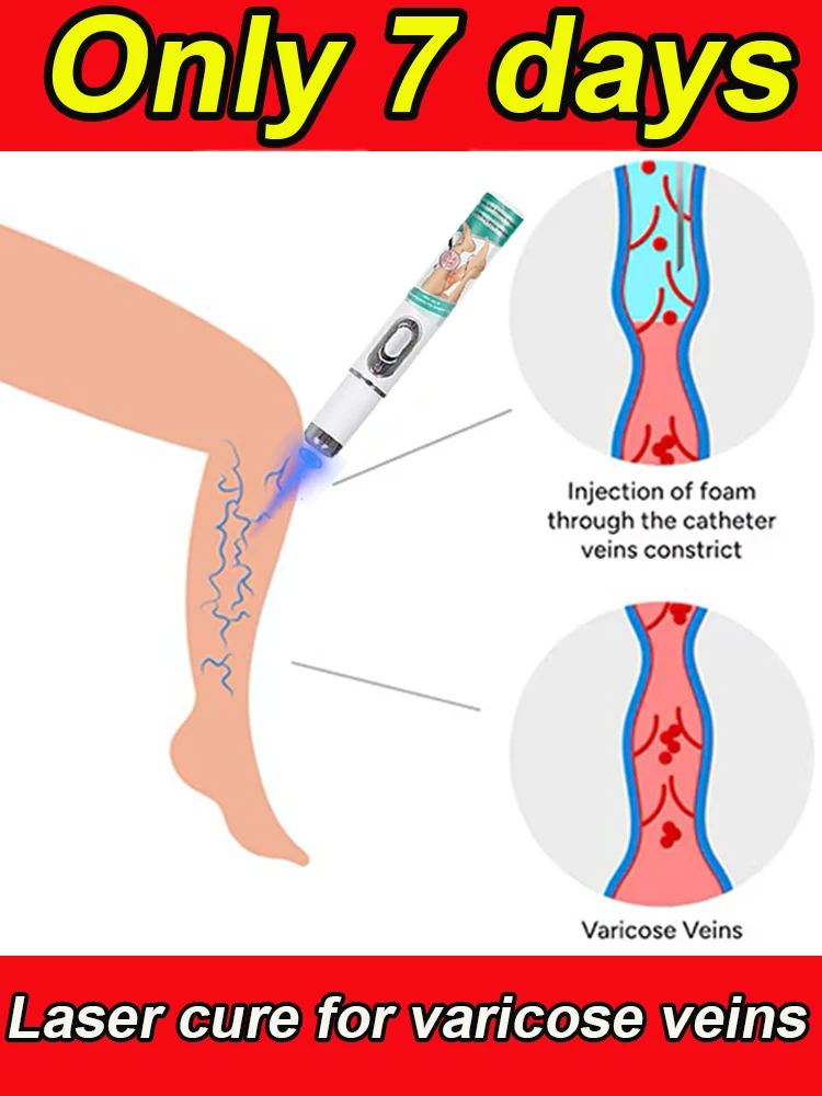 GENERATION-2 LASER VANISH Varicose/Spider Veins
GENERATION-2 LASER VANISH Varicose/Spider Veins