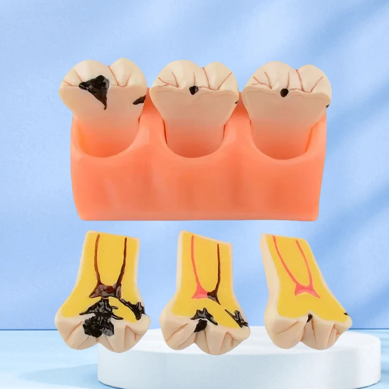 Инструменты для обучения стоматологом, модель гнездовых зубов, протез, кариес, болезнь, модель зуба, разложение, модель кариеса
Инструменты для обучения стоматологом, модель гнездовых зубов, протез, кариес, болезнь, модель зуба, разложение, модель кариеса