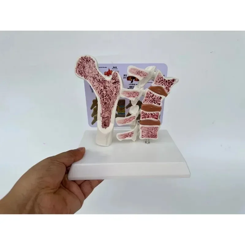 Anatomy Human Femoral Osteoporosis Anatomical Surface of Leg Bone Spinal Section Specimen Lesion Lumbar Spine Model
Anatomy Human Femoral Osteoporosis Anatomical Surface of Leg Bone Spinal Section Specimen Lesion Lumbar Spine Model