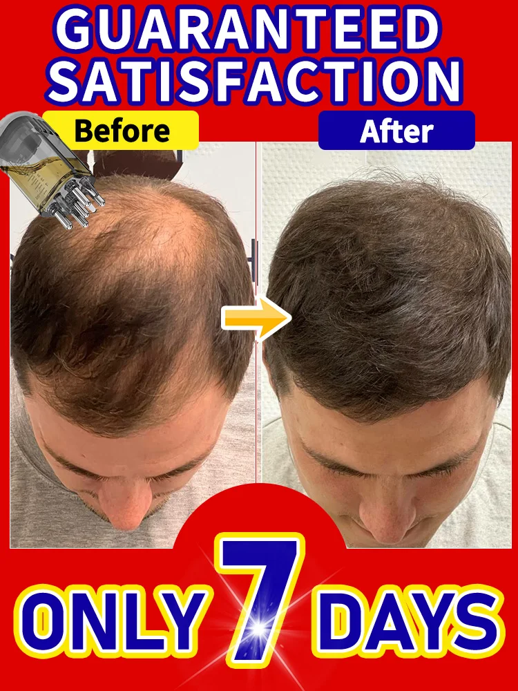 Portable Scalp Applicator Liquid Comb Hair Roots Massage Medicine Comb Hair For Hair Growth Serum Oil Nourish Massager Brush
Portable Scalp Applicator Liquid Comb Hair Roots Massage Medicine Comb Hair For Hair Growth Serum Oil Nourish Massager Brush